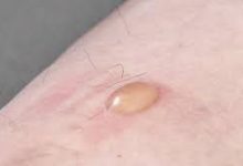 Yellowish or skin-colored bumps