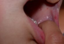 Rashes on The Skin or Inside of The Mouth