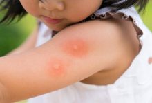 Cellulitis from Bug