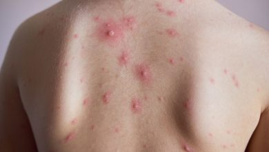 Skin Rash or Lesion with Pain