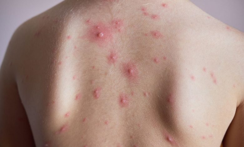 Skin Rash or Lesion with Pain