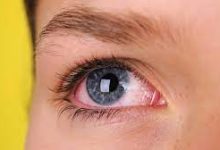 Redness of the Eye