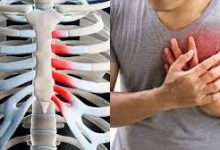 Home Treatments for Costochondritis Symptoms