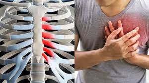 Home Treatments for Costochondritis Symptoms