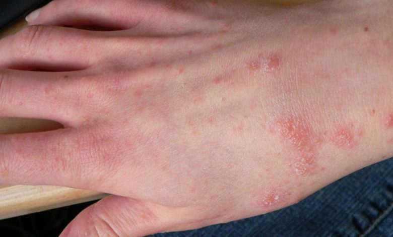 Ringed Red Bumps on The Back of The Hands