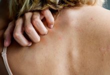 Itchiness on the Affected Areas of Skin