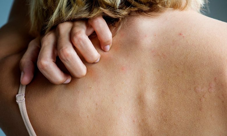 Itchiness on the Affected Areas of Skin