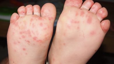 Ringed Red Bumps on Soles of Feet