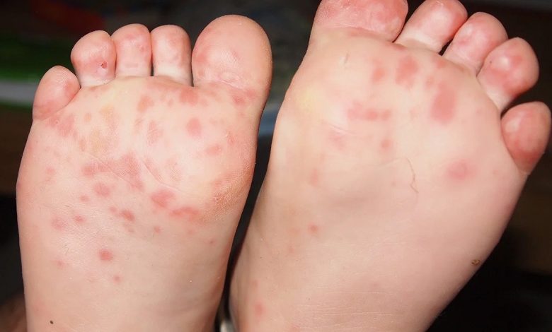 Ringed Red Bumps on Soles of Feet