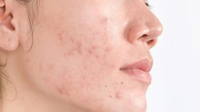 Hyperpigmentation in the Affected Areas