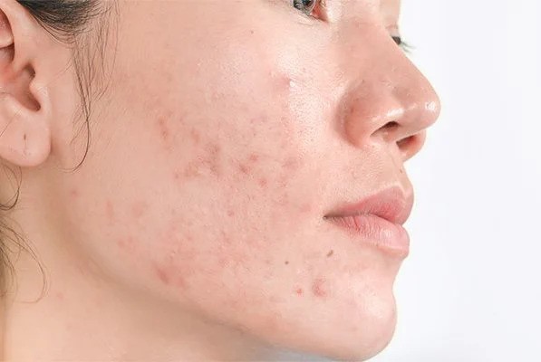 Hyperpigmentation in the Affected Areas