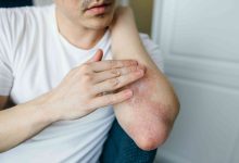 Itching on the Affected Area