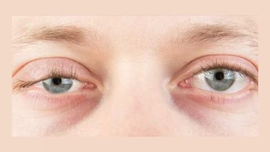 Weakening of Eye Muscles