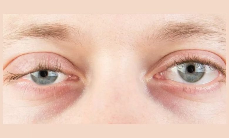 Weakening of Eye Muscles