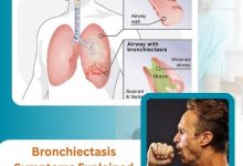 Bronchiectasis Symptoms Explained Clearly