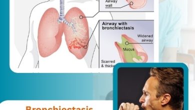 Bronchiectasis Symptoms Explained Clearly