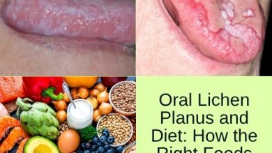 Oral Lichen Planus and Diet