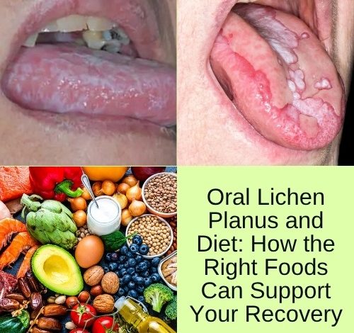 Oral Lichen Planus and Diet