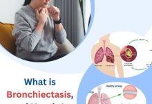 What is Bronchiectasis