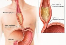Medical illustration showing achalasia affecting the esophagus and lower esophageal sphincter