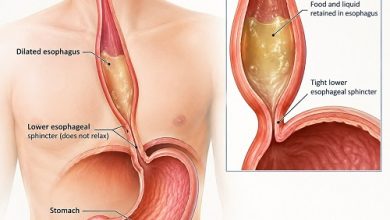 Medical illustration showing achalasia affecting the esophagus and lower esophageal sphincter