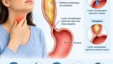 Achalasia symptoms showing difficulty swallowing and food movement through the oesophagus