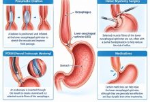 Achalasia treatment options showing the oesophagus and lower oesophageal sphincter