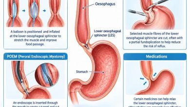 Achalasia treatment options showing the oesophagus and lower oesophageal sphincter