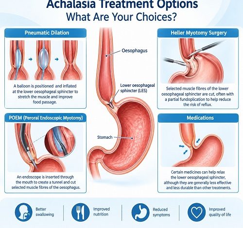 Achalasia treatment options showing the oesophagus and lower oesophageal sphincter