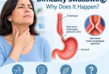 Achalasia and difficulty swallowing showing impaired food movement through the oesophagus