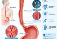 Achalasia causes and esophageal nerve damage affecting the oesophagus