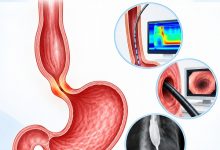 How Is Achalasia Diagnosed