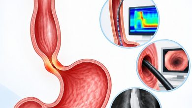 How Is Achalasia Diagnosed
