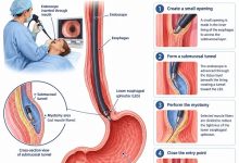 POEM for achalasia procedure showing an endoscope performing peroral endoscopic myotomy