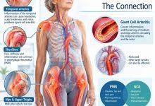 Polymyalgia Rheumatica and Giant Cell Arteritis affecting the shoulders, hips and blood vessels