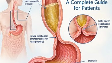 Medical illustration showing esophageal achalasia with a dilated esophagus and narrowed lower esophageal sphincter