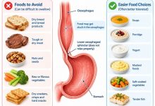 Foods to avoid with achalasia and easier food choices for swallowing