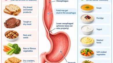Foods to avoid with achalasia and easier food choices for swallowing