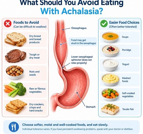 Foods to avoid with achalasia and easier food choices for swallowing