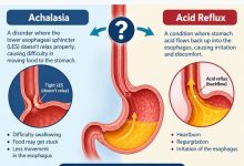 SEO title Achalasia and Acid Reflux: Are They Connected? Meta description Learn how achalasia and acid reflux differ, why heartburn can occur, and how reflux after achalasia treatment is diagnosed and managed. Slug / URL achalasia-and-acid-reflux Focus keyword achalasia and acid reflux Secondary keywords GERD, reflux after achalasia treatment, heartburn Image alt text Medical illustration showing achalasia of the oesophagus, the lower oesophageal sphincter and the stomach, highlighting how swallowing difficulties and acid reflux can differ. Post tags Achalasia, Acid Reflux, GERD, Heartburn, Oesophageal Disorders, Achalasia Treatment, Digestive Health, Reflux After Achalasia Treatment
