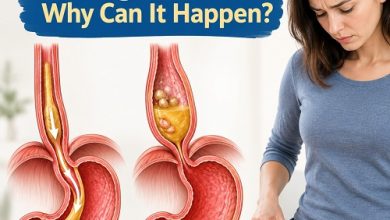 Medical illustration showing an enlarged oesophagus and a tight lower oesophageal sphincter in achalasia, explaining difficulty swallowing and weight loss.