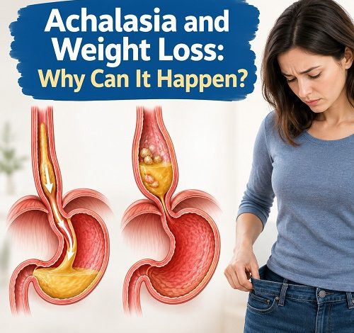 Medical illustration showing an enlarged oesophagus and a tight lower oesophageal sphincter in achalasia, explaining difficulty swallowing and weight loss.