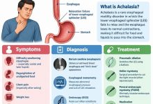 Medical illustration showing achalasia in adults, an enlarged oesophagus and a tight lower oesophageal sphincter that restricts food passage into the stomach.