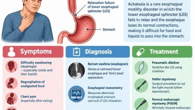 Medical illustration showing achalasia in adults, an enlarged oesophagus and a tight lower oesophageal sphincter that restricts food passage into the stomach.