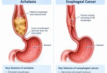 Achalasia vs esophageal cancer showing oesophageal muscle dysfunction and tumour-related narrowing