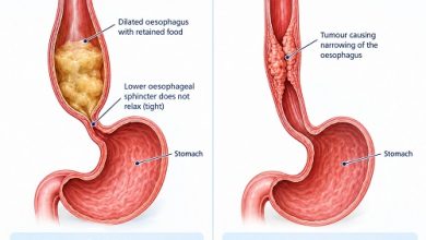 Achalasia vs esophageal cancer showing oesophageal muscle dysfunction and tumour-related narrowing