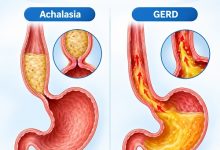Achalasia vs GERD