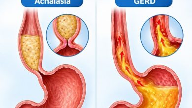 Achalasia vs GERD