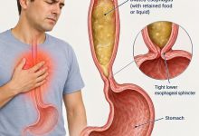 Medical illustration showing achalasia and chest pain caused by food buildup in the esophagus