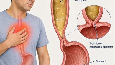Medical illustration showing achalasia and chest pain caused by food buildup in the esophagus